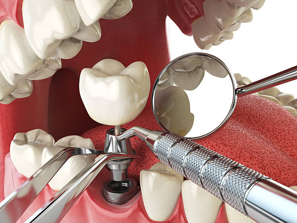 Best Emergency Denture Repair in Framingham, MA